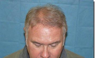 Hair restoration procedure results