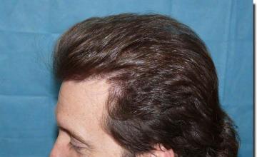 Hair restoration procedure results