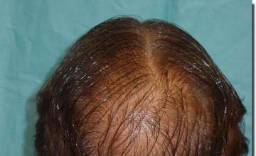 Hair restoration procedure results