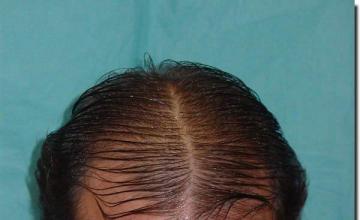 Hair restoration procedure results