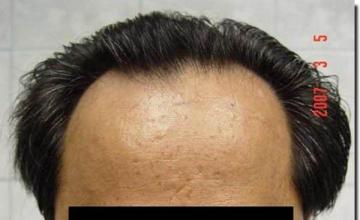 Hair restoration procedure results