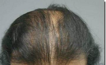 Hair restoration procedure results