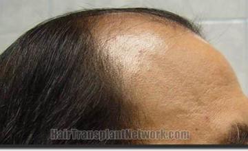 Hair restoration procedure results