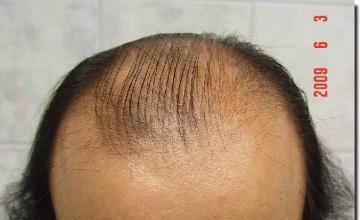 Hair restoration procedure results