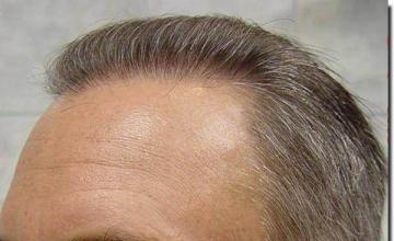 Hair restoration procedure results