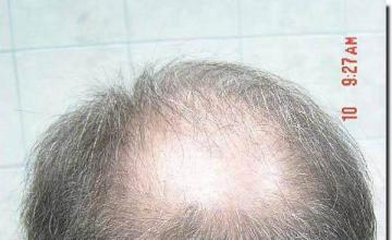 Hair restoration procedure results