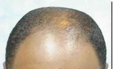 Hair restoration procedure results