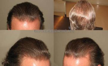 Hair transplantation surgery before and after images