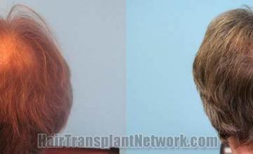 Hair restoration procedure before and after pictures