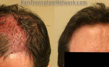 Hair restoration procedure results