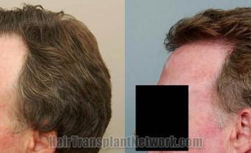  result photos from 2614 grafts