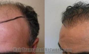 Hair transplantation surgery before and after pictures