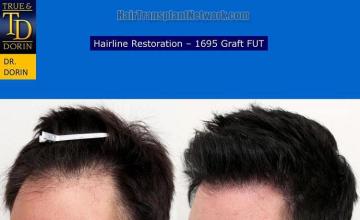 Hair transplantation surgery before and after pictures