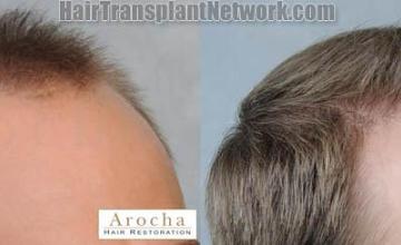 Hair transplantation surgery before and after photos