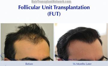 Surgical hair transplantation result photographs