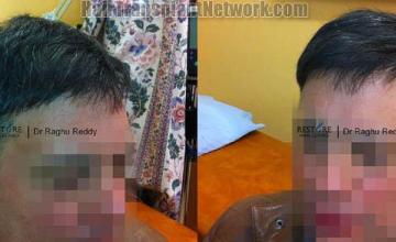 Hair transplantation surgery before and after images