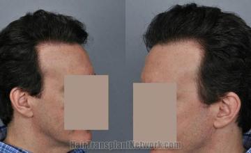 Hair transplantation surgery before and after photos