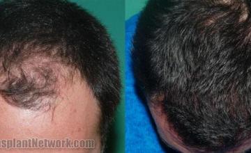 Before and after hair transplant procedure images