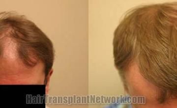 Hair transplantation surgery before and after photos