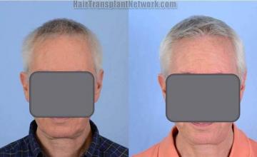 Hair transplantation surgery before and after photos