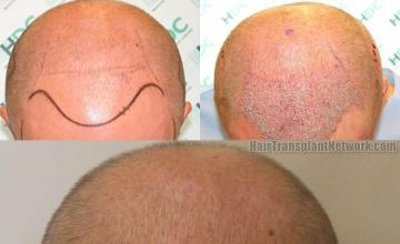 Hair restoration procedure before and after results