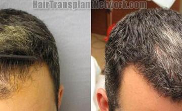 Hair transplantation surgery before and after images