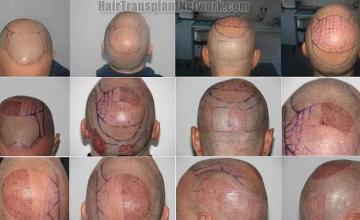 Hair transplantation surgery before and after photos