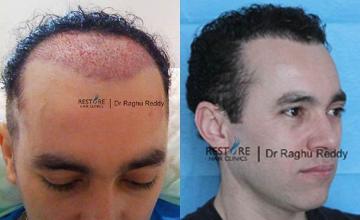 Hair restoration procedure before and after pictures