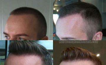 Hair transplantation surgery before and after pictures