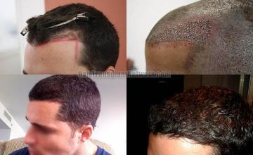 Hair transplantation surgery before and after images