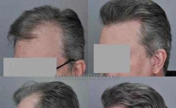 Hair transplantation surgery before and after pictures