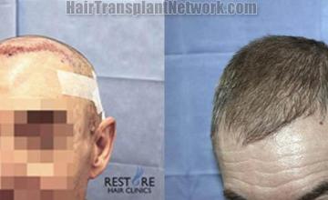 Hair transplantation surgery before and after pictures