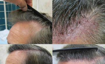 Hair restoration procedure before and after pictures