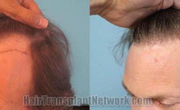 Hair transplantation surgery before and after pictures