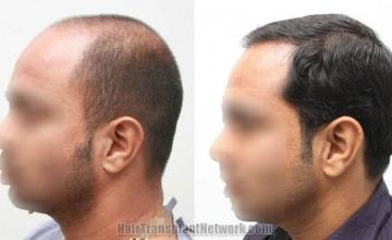 Surgical hair transplantation result photographs