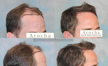 Right view - before and postoperative hair transplant results