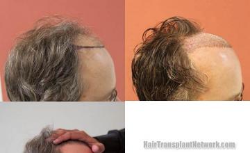 Hair transplantation surgery before and after photos