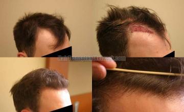 Hair transplantation surgery before and after photos