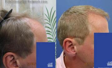 Hair transplantation surgery before and after pictures