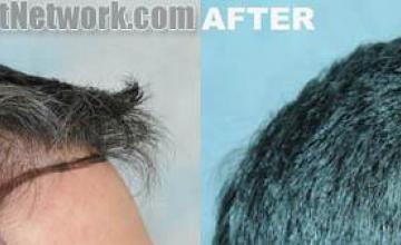 Hair transplantation surgery before and after photos