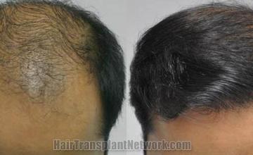 Hair transplantation surgery before and after pictures