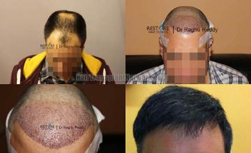 Hair restoration procedure before and after results