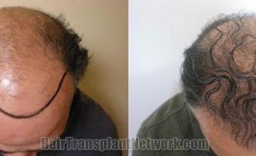 Hair transplantation surgery before and after photos