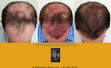 Hair transplantation surgery before and after photos