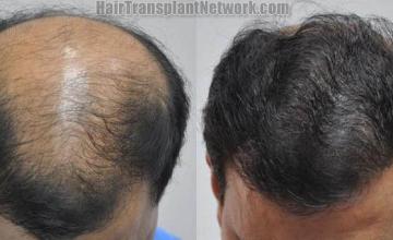 Top view - Before and after surgical hair replacement