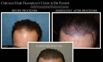 Hair restoration procedure before and after results