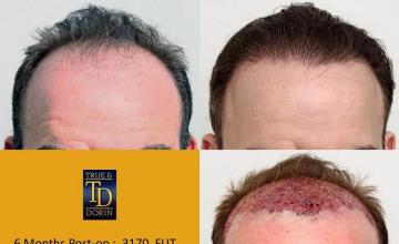 Hair restoration procedure before and after results