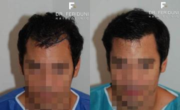 Hair restoration procedure before and after results