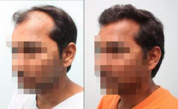 Hair transplantation surgery before and after pictures