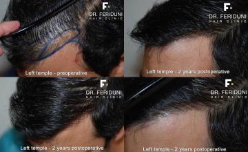 Hair restoration surgery before and after photos